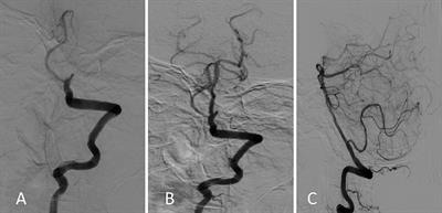 Symptoms similar to Kleine–Levin syndrome in a patient with basilar artery occlusion: a case report and literature review
